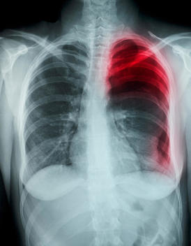 Chest x-ray showing pneumothorax