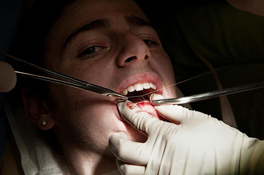 A Dental Surgeon Sewing A Boy'S Lip Closed.