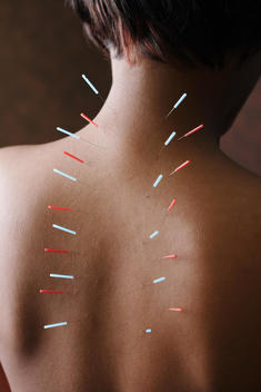 Acupuncture needles in African woman\'s back