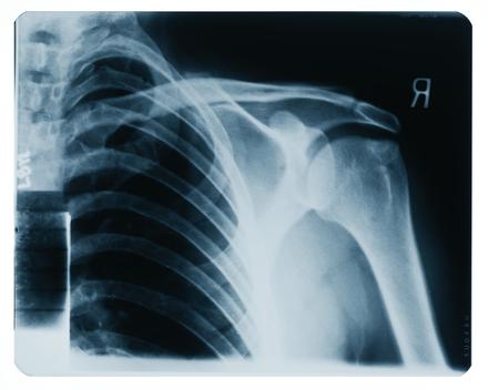 Shoulder & Torso x-Ray Film