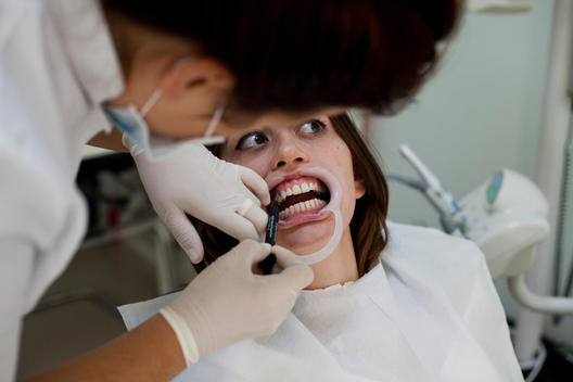 Dental patient are getting her teeth whitening, while the dentist are putting blue glue around her patient s teeth.
