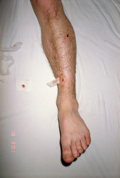 Leg of young man with lacerations from dog attack.