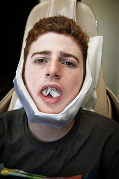 A Patients Recovering After Having Their Wisdom Teeth Removed.