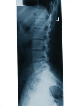 Spine x-Ray