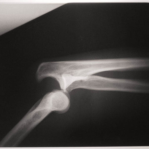 X-Ray With Dislocated Arm Joints