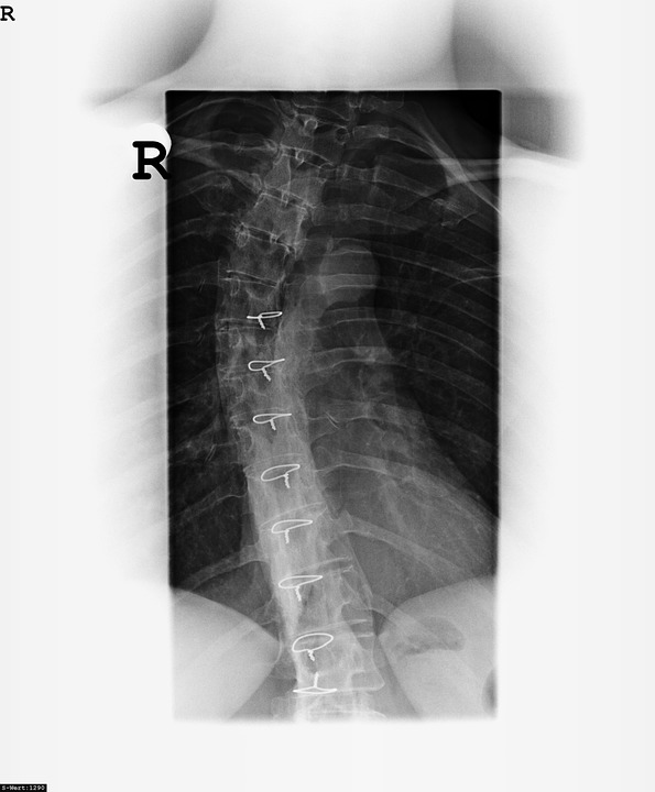 x ray image, bone, spine