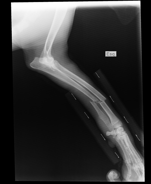 broken arm, x-ray, shin