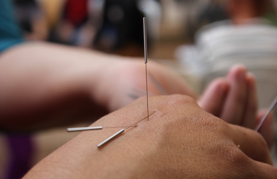 acupuncture, needles, hand