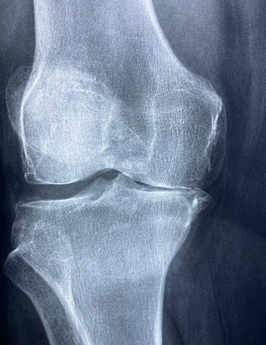 knee, x rays, arthritis