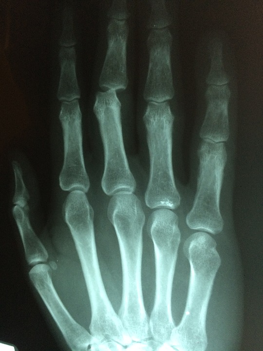 hand, fracture, broken