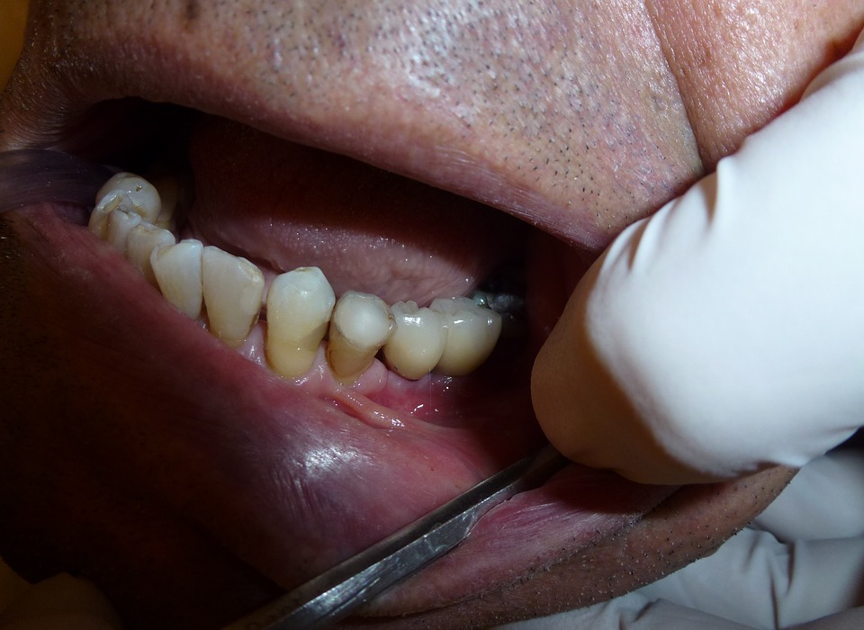 implant, dentistry, dentist