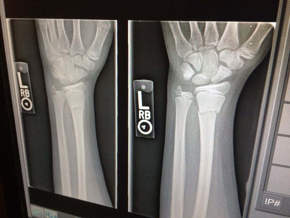 x-ray, medical, broken