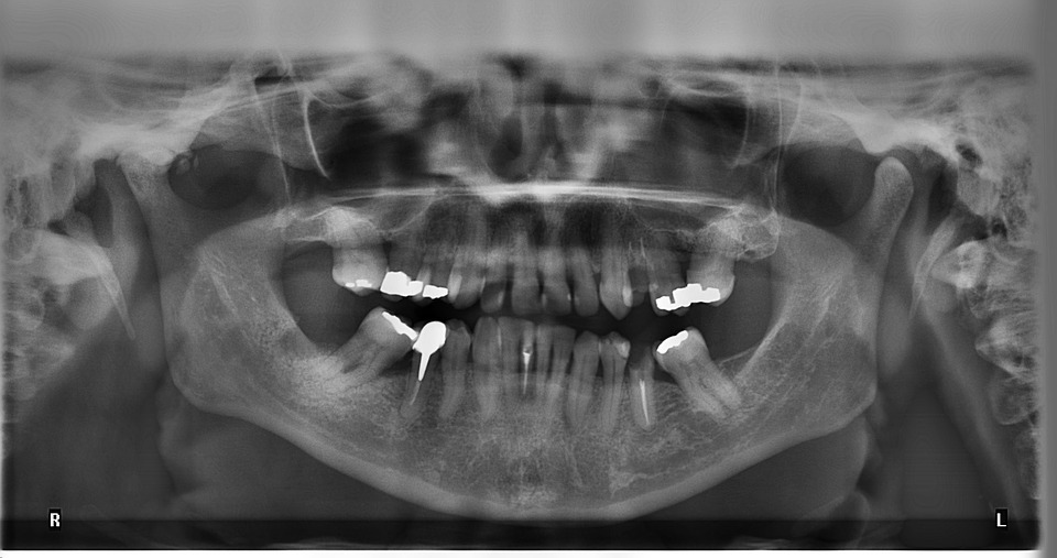 x-ray, tooth, radius