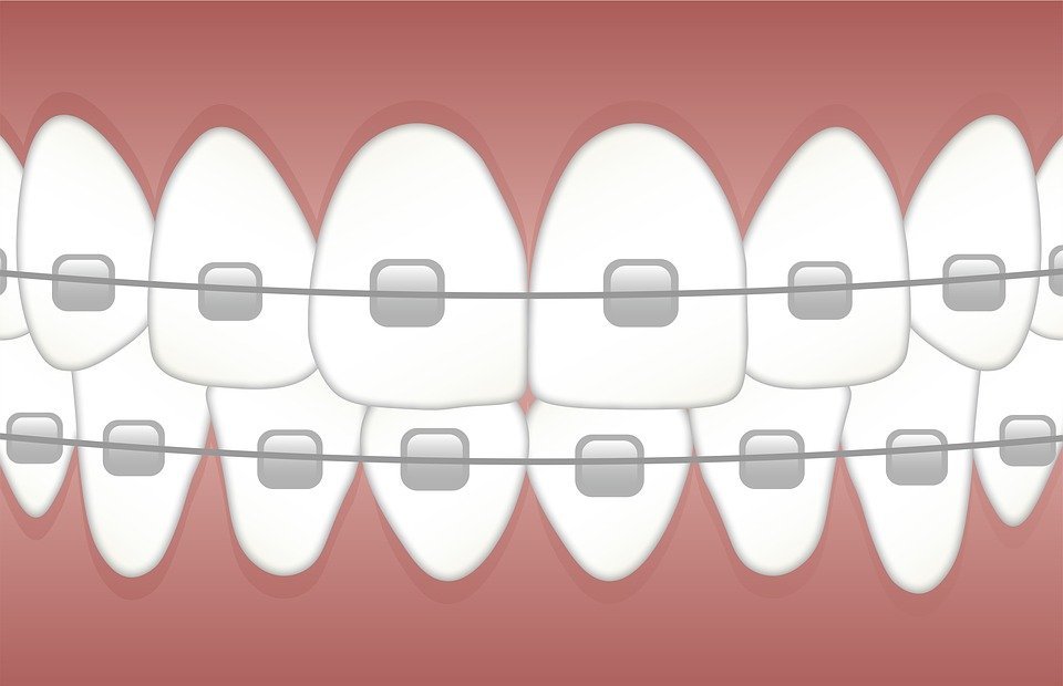 braces, teeth, dentist
