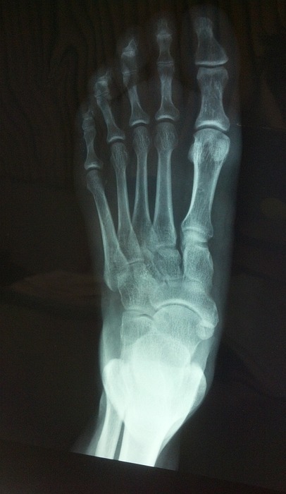 x ray, foot, bone