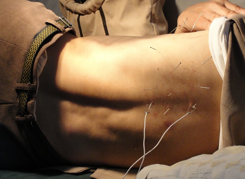 acupuncture, man, needles