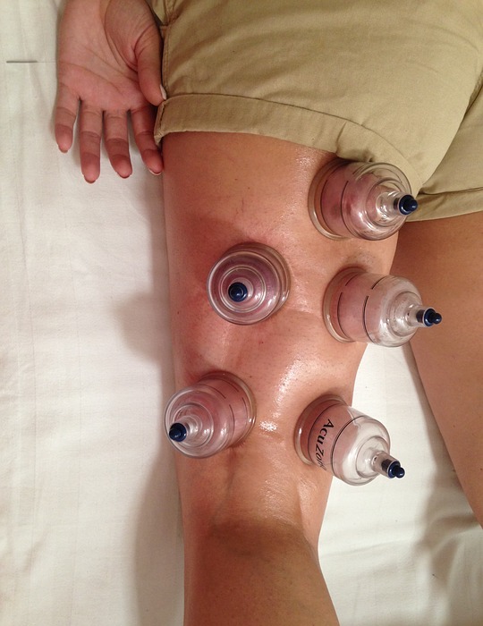 cupping, acupuncture, alternative