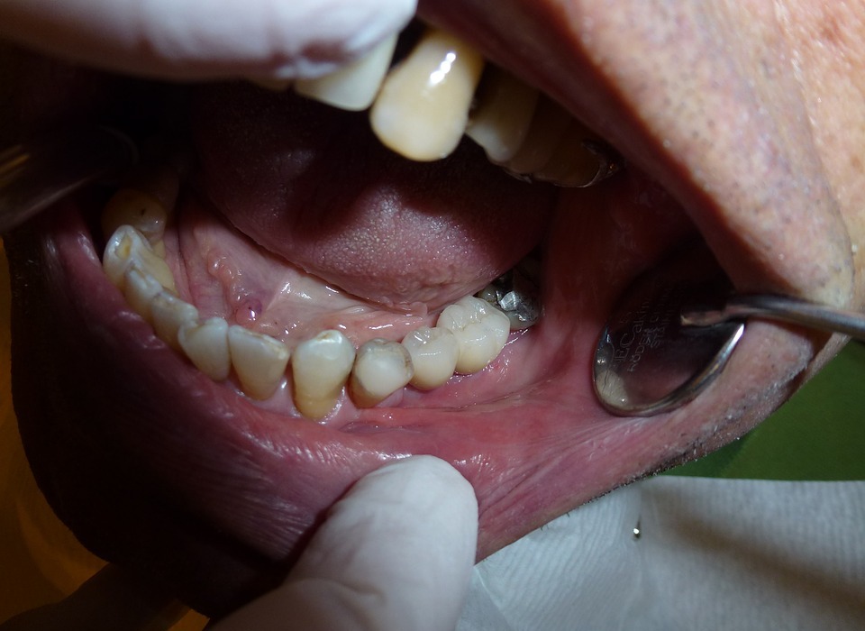 implant, dentistry, dentist