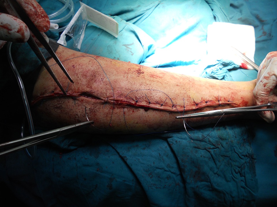 surgery, orthopedic, arm