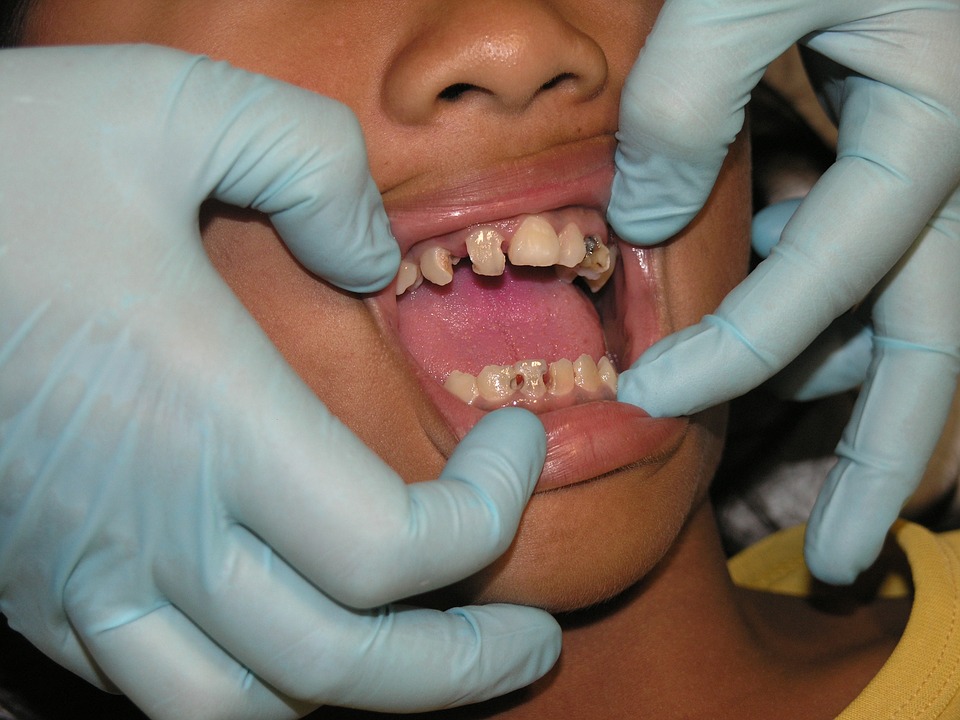 bad teeth, toothache, dental treatment